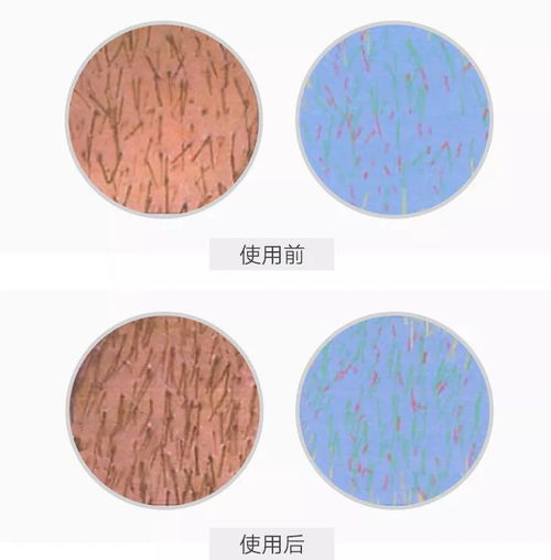 杨幂发际线变低还长出许多小绒毛,真的去植发了